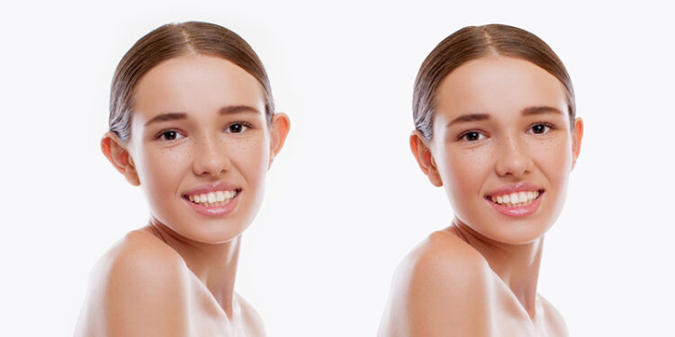 SOSYAL MEDYANIN YENİ ÇILGINLIĞI: KEPÇE KULAK BANTLARI