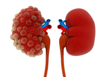 “Polikistik böbrek hastalığı yavaş gelişir, her şey hızla değişir”