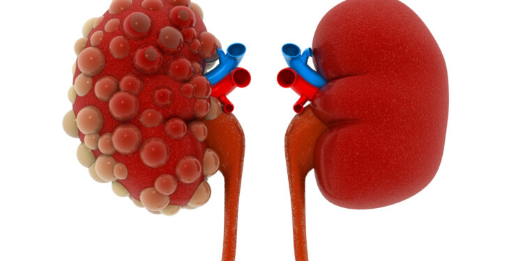 “Polikistik böbrek hastalığı yavaş gelişir, her şey hızla değişir”