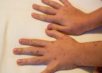 Sabri Ülker Vakfı, Mpox (Maymun Çiçeği) hakkında bilinmesi gerekenleri açıkladı