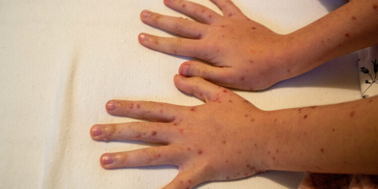 Sabri Ülker Vakfı, Mpox (Maymun Çiçeği) hakkında bilinmesi gerekenleri açıkladı