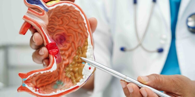 Mide Yanması ve Reflüye Son!