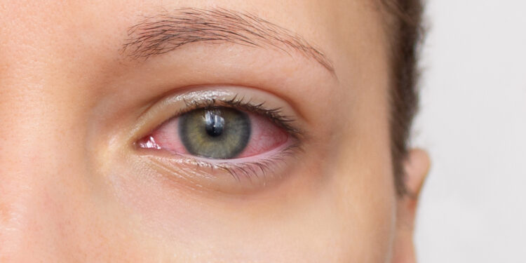 Bulaşıcı göz hastalıklarına dikkat!